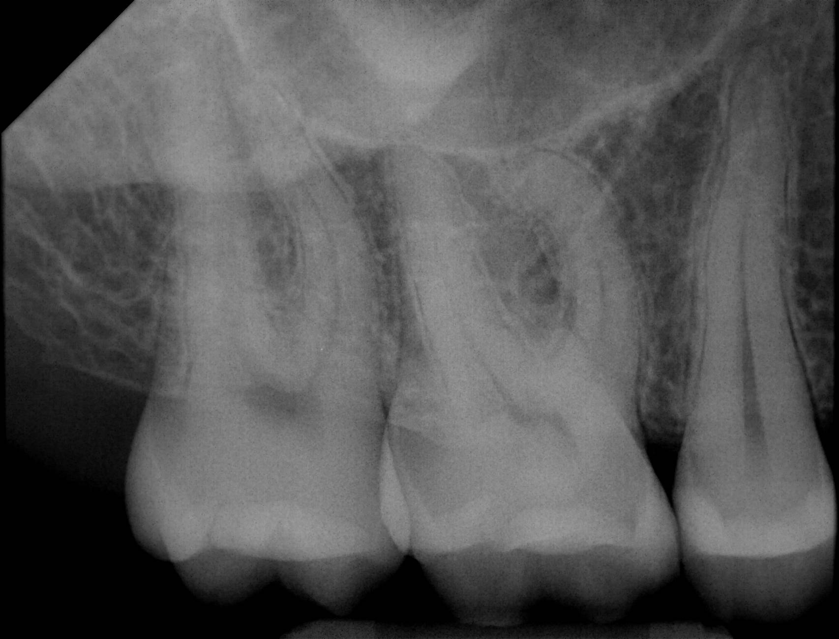 Apex sample X-ray 1