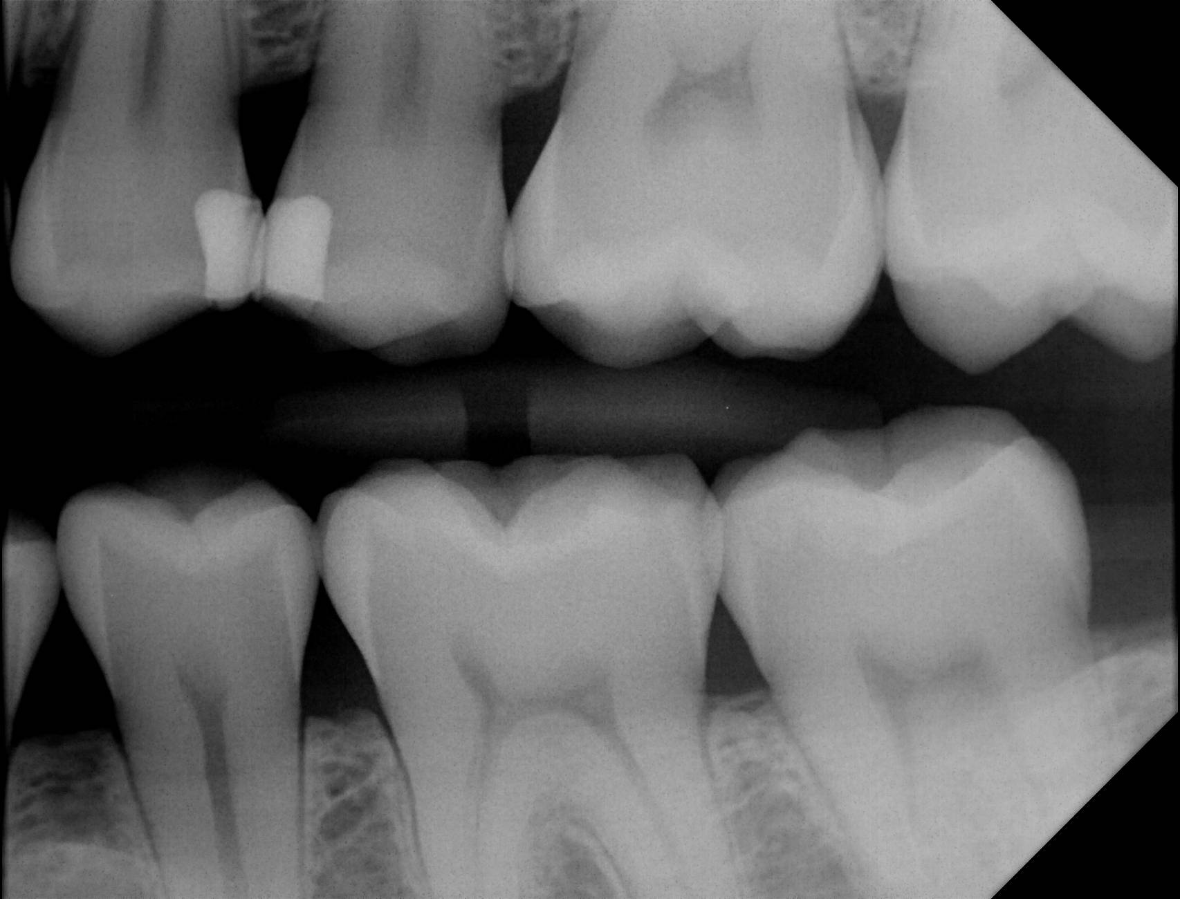 Apex sample X-ray 10