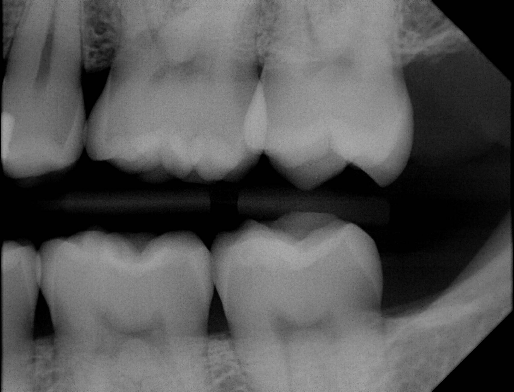 Apex sample X-ray 11