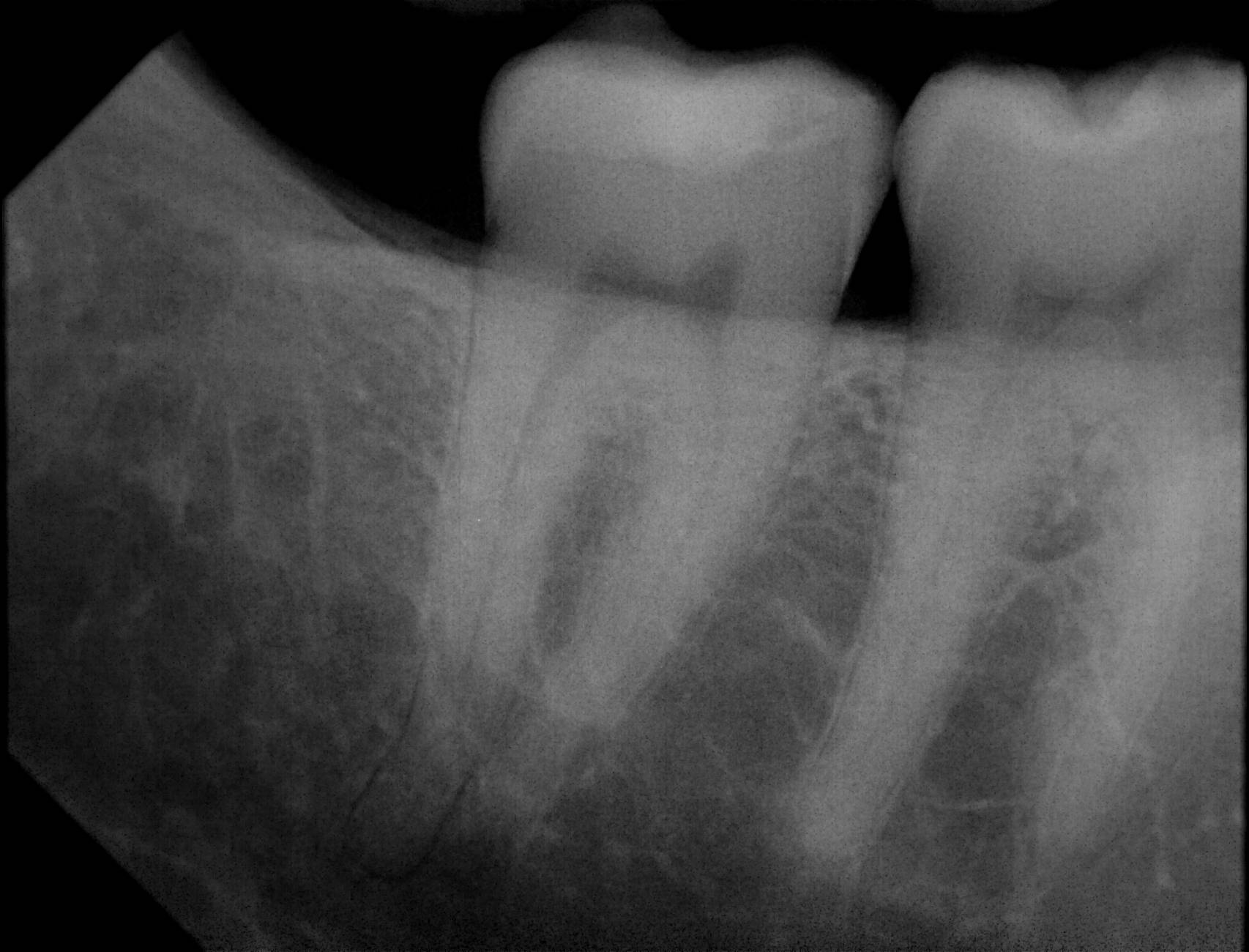 Apex sample X-ray 12