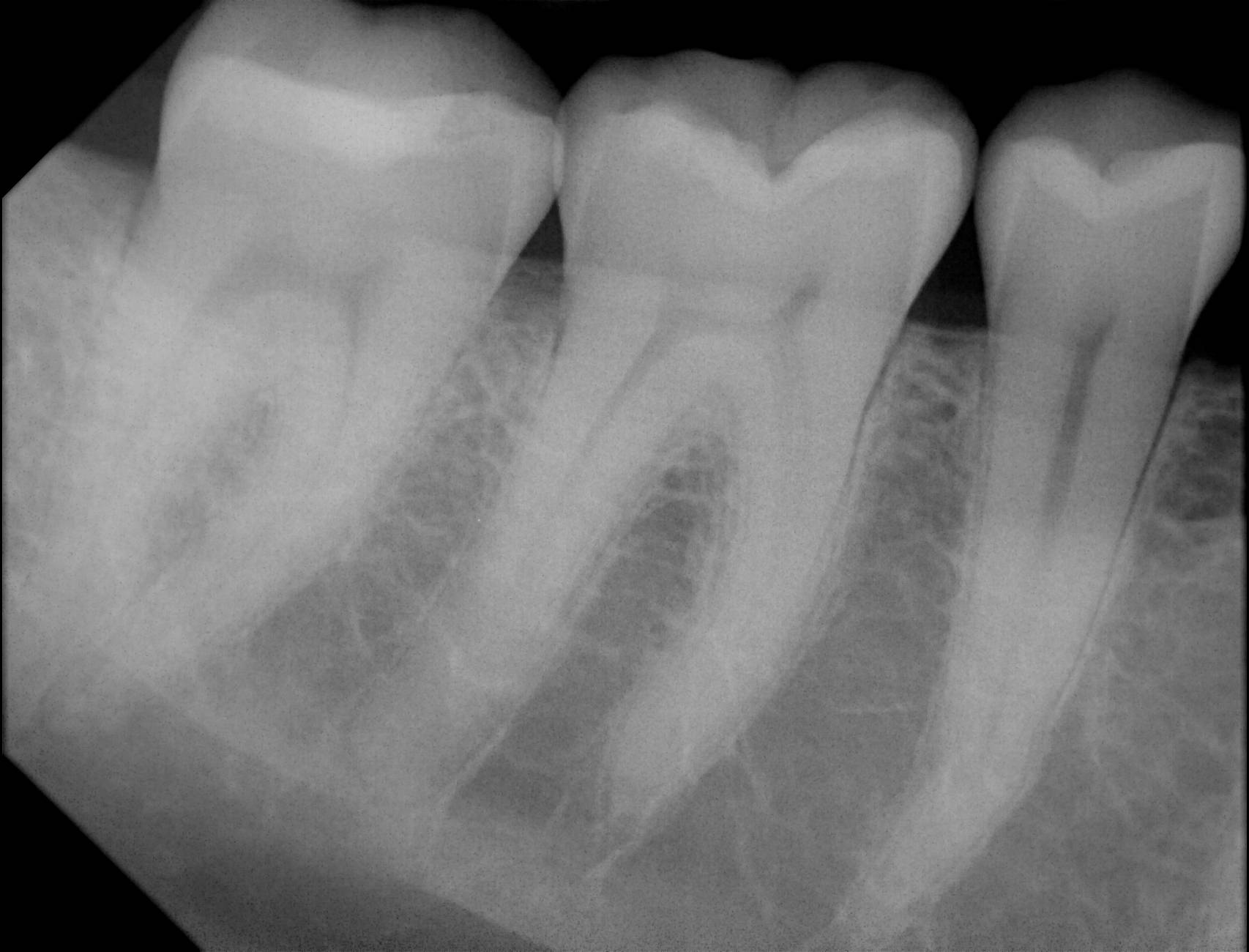 Apex sample X-ray 13