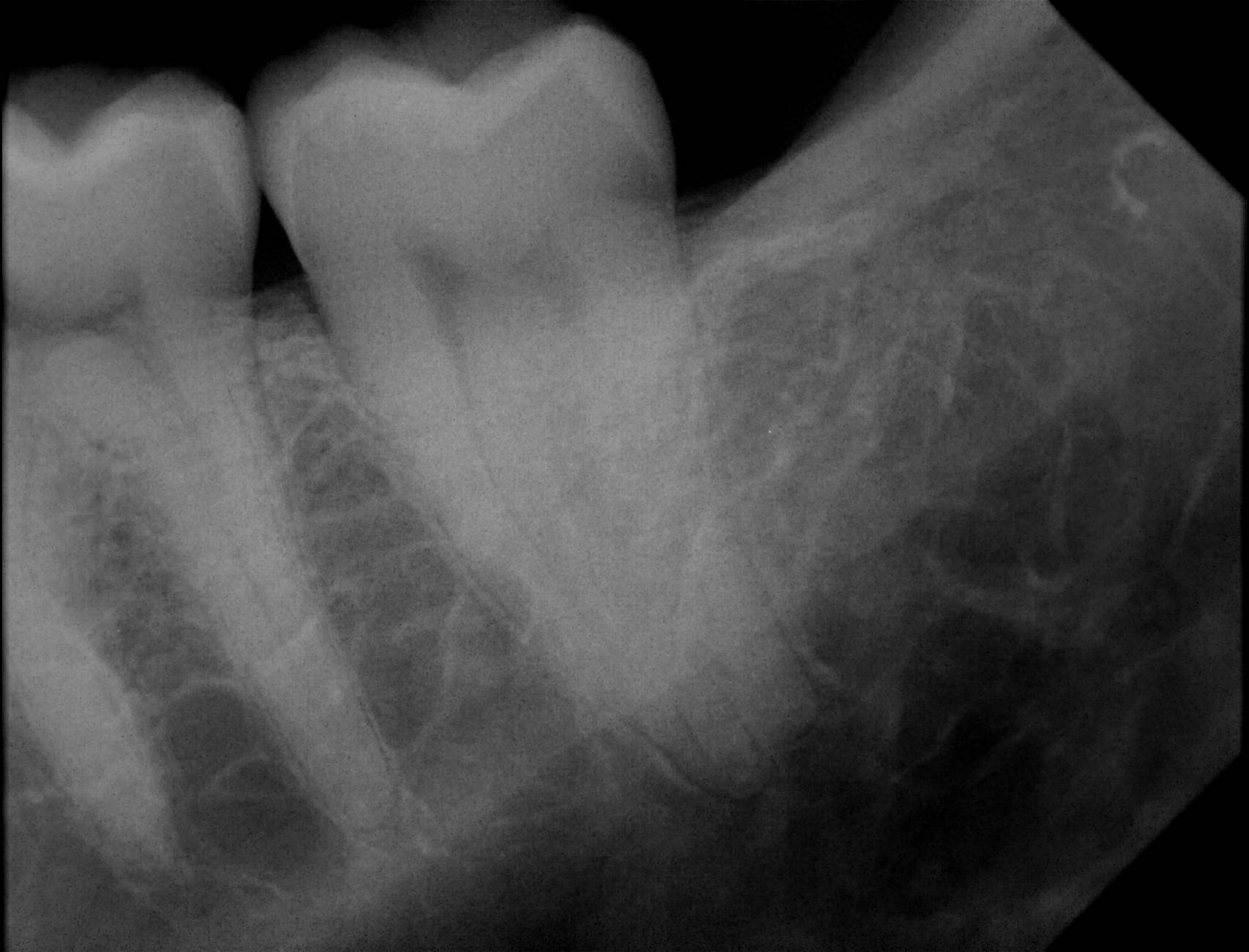 Apex sample X-ray 18