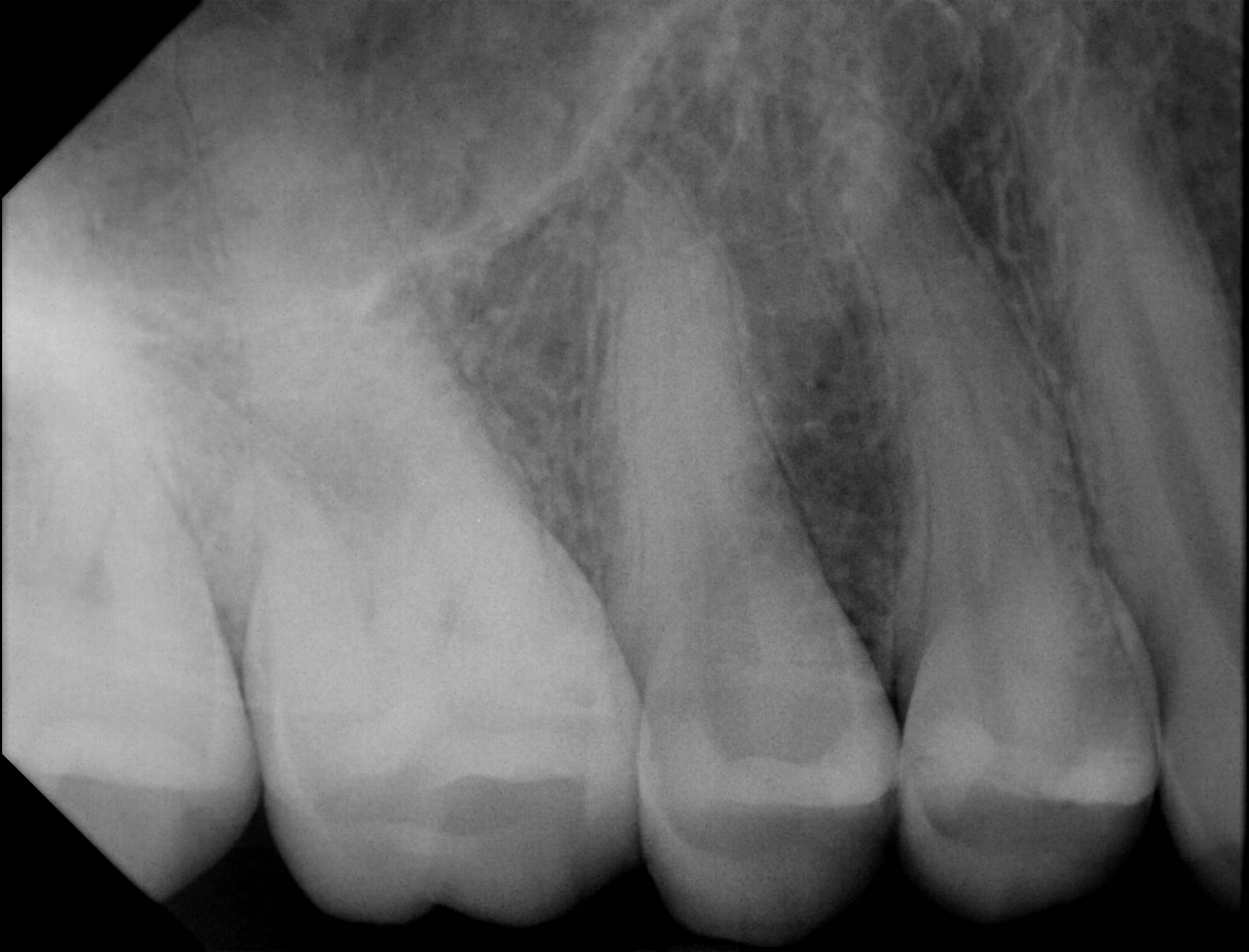 Apex sample X-ray 2