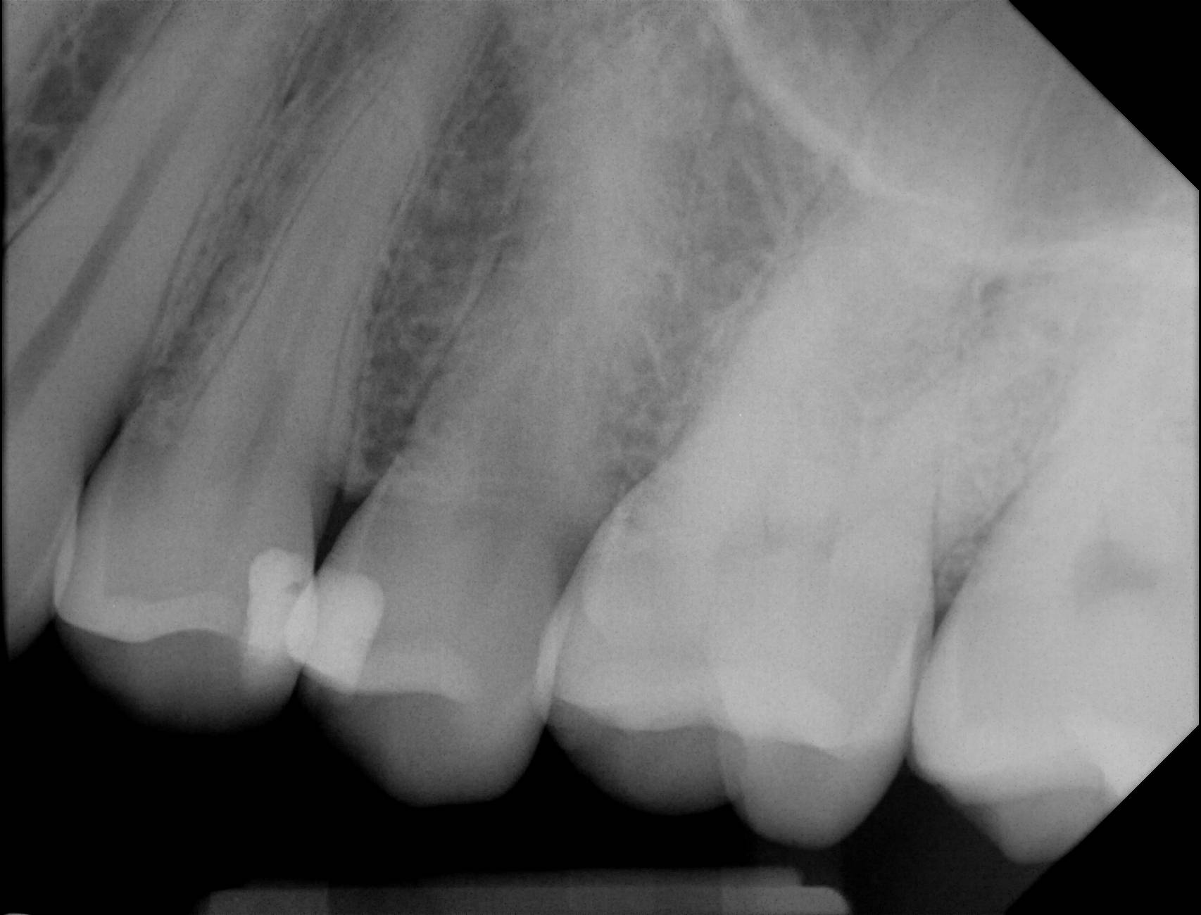 Apex sample X-ray 6