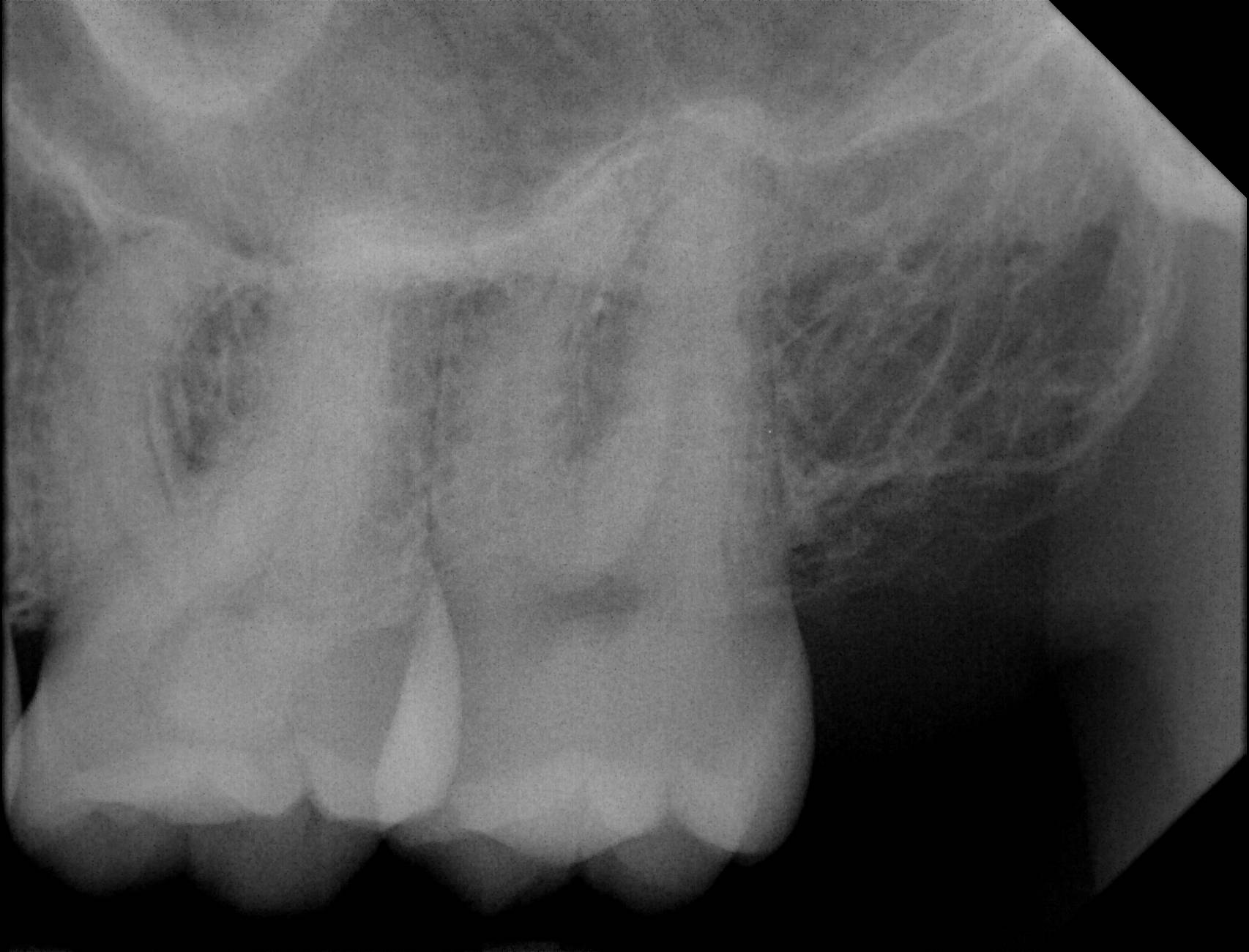 Apex sample X-ray 7