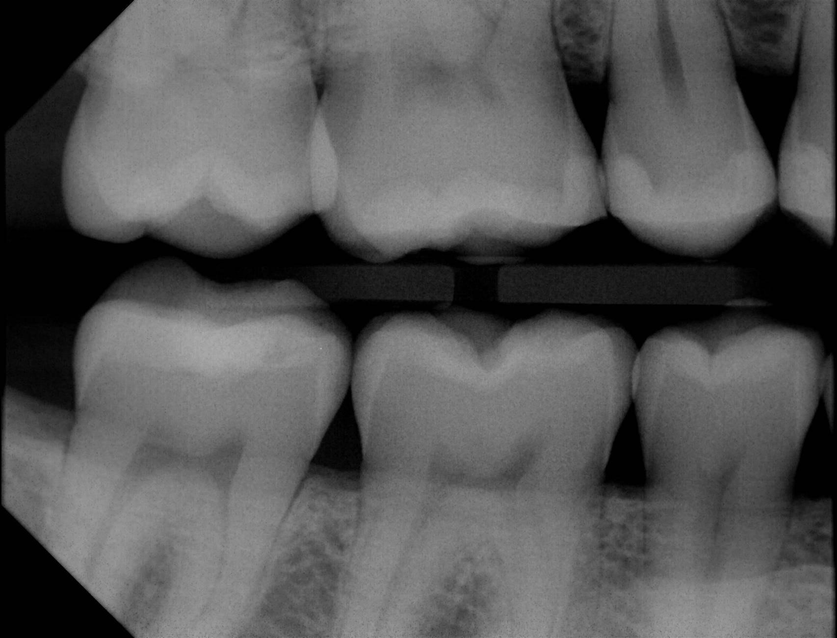 Apex sample X-ray 8