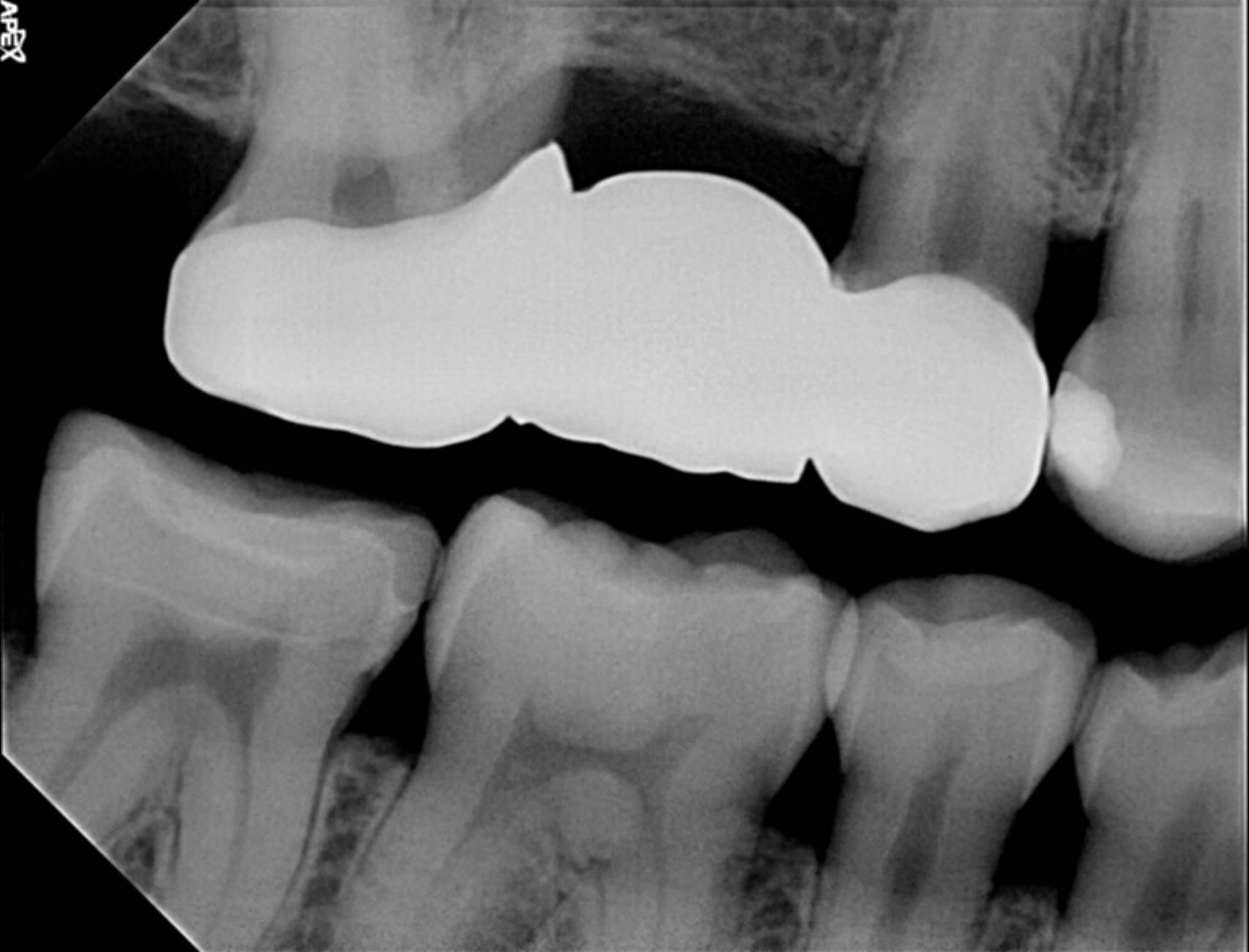 Apex handheld X-ray · source image marked enhanced