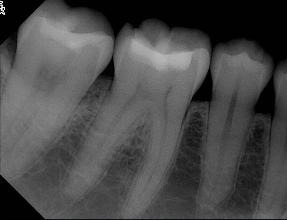 Apex sample X-ray · 10/26/2017