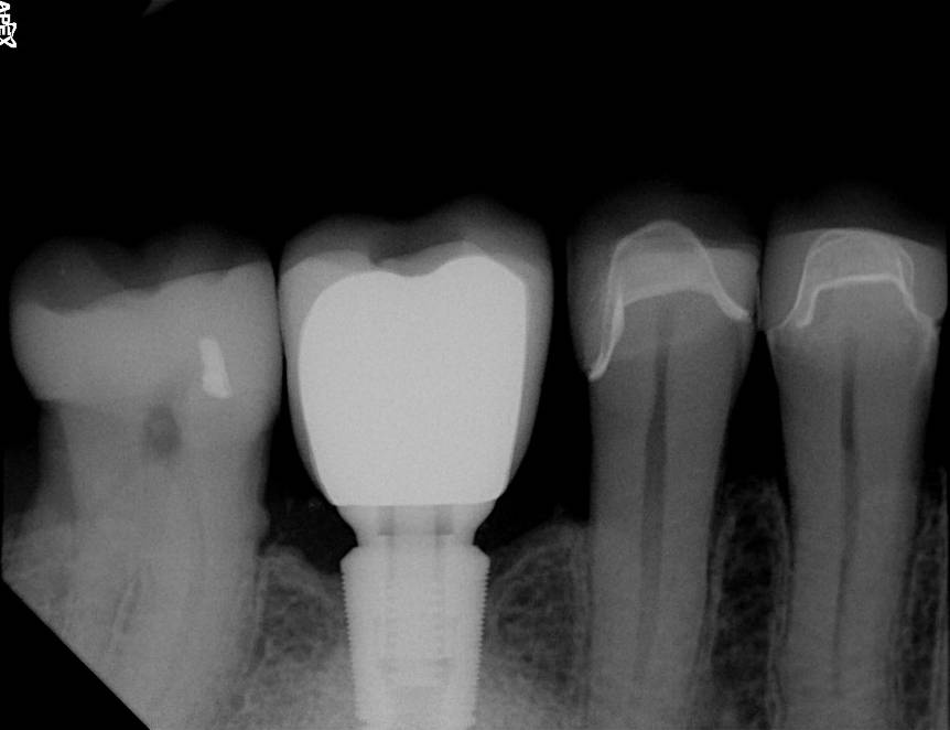 Apex sample X-ray · 10/27/2017