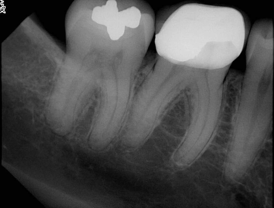 Apex sample X-ray · 6/26/2018