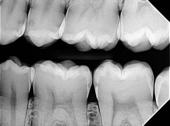 Apex sample X-ray with caries