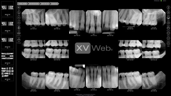 Actual XVWeb imaging software showing Apex dental radiographs